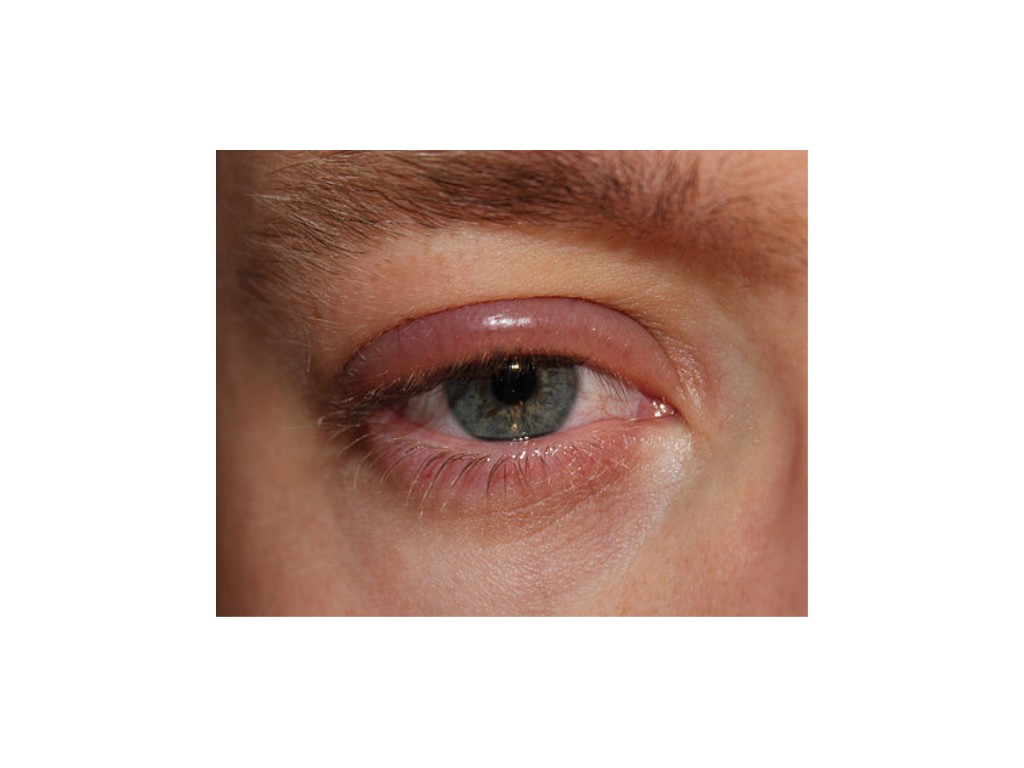 Blépharite, conjonctivite, troubles&nbsp;oculaires