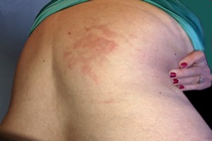 Soigner la grippe, le zona avec des huiles&nbsp;essentielles